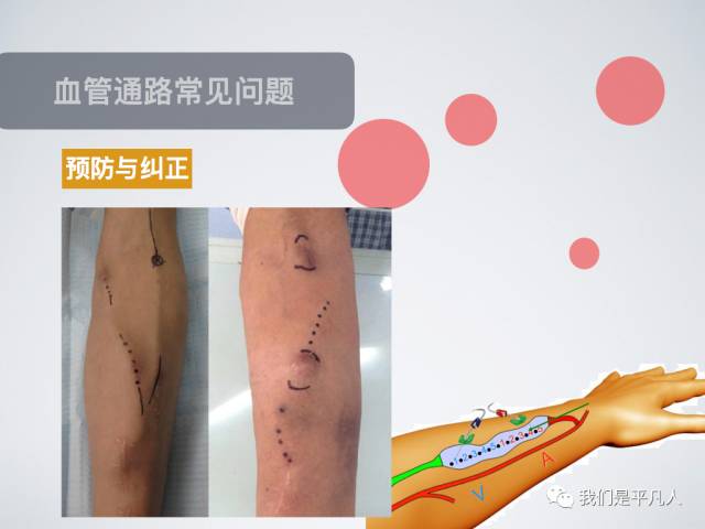 血透净化标准操作规程,血透护理科普怎么完成