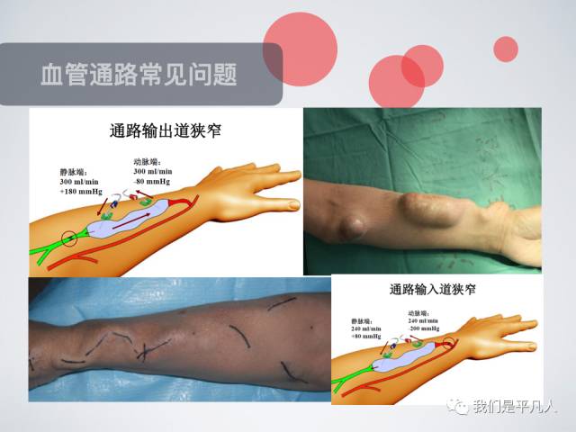 血透净化标准操作规程,血透护理科普怎么完成