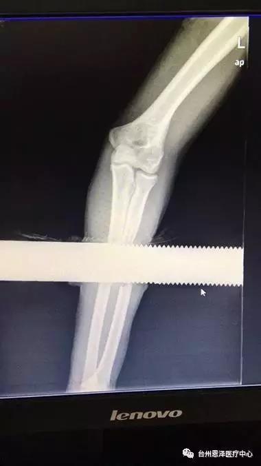 男子手臂被栏杆穿透防火救援,男子手被撞断惊险瞬间