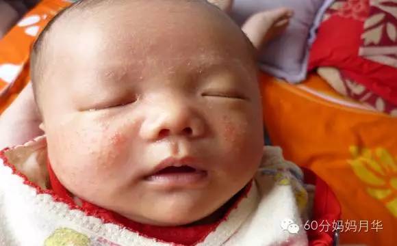 蚊子包止痒宝宝,怎么区分蚊子包和湿疹