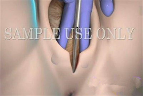 图片全程为你揭秘：产妇分娩侧切全过程