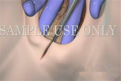 图片全程为你揭秘：产妇分娩侧切全过程