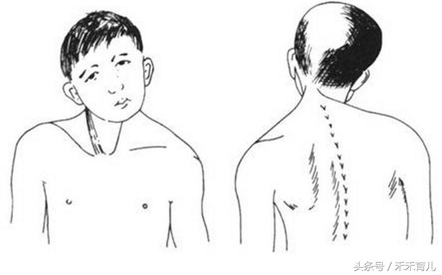 宝宝因为习惯导致的斜颈怎么纠正,大人抱姿导致宝宝斜颈