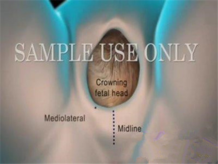 图片全程为你揭秘：产妇分娩侧切全过程