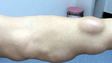 什么样的人最易得脂肪瘤,颈部脂肪瘤会致命吗