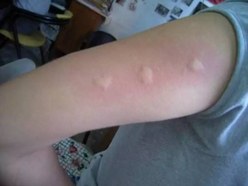 蚊子包止痒宝宝,怎么区分蚊子包和湿疹