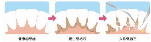 怀孕为什么不能洗牙,为什么怀孕前要检查