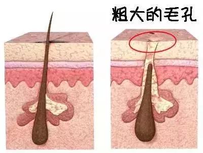 为什么你的毛孔会又黑又大,毛孔粗大怎么办方法其实很简单