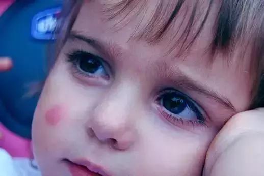 为什么蚊子只咬你一个人,为什么蚊子只咬你的脸