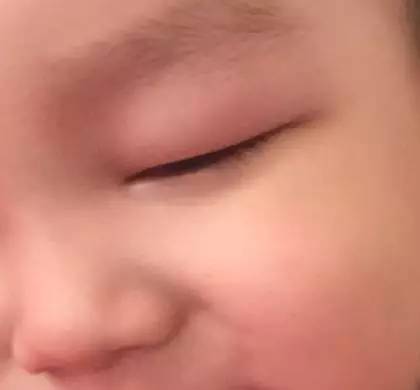 蚊子包止痒宝宝,怎么区分蚊子包和湿疹