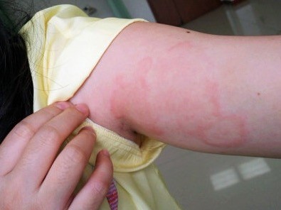 为什么嘴唇一夜之间会肿成香肠嘴,嘴唇起麻疹怎么办