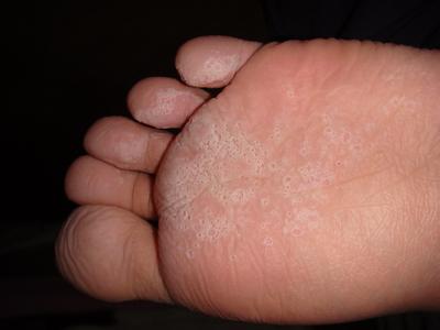 夏季来临，我的脚气病怎么治好？