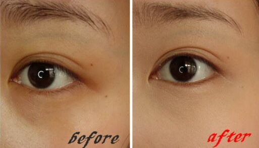 怎样快速有效的去除黑眼圈,小孩有黑眼圈怎么能快速去除