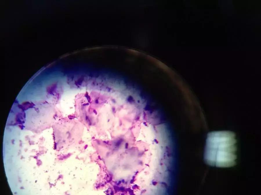 出油黑头毛孔粗大怎么办,毛孔粗大黑头多脸爱出油怎么解决