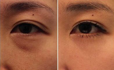 怎样快速有效的去除黑眼圈,小孩有黑眼圈怎么能快速去除