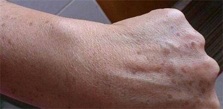 激光祛老年斑结痂13天不掉正常吗,老年斑用激光祛斑最有效方法