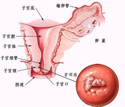 你以为HPV与你无关，可它却曾带走过当红女星的命