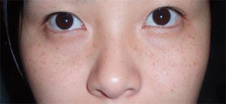 遗传性雀斑激光祛除后会反弹吗,初中生遗传性雀斑怎么去除