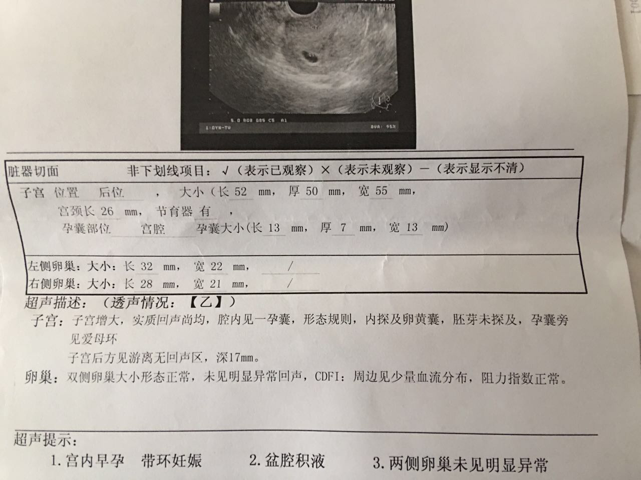 What?上环都能怀孕！千万别认为上了环就可以高枕无忧了
