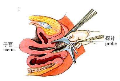 上环取环的相关要点,上环取环你了解多少呢