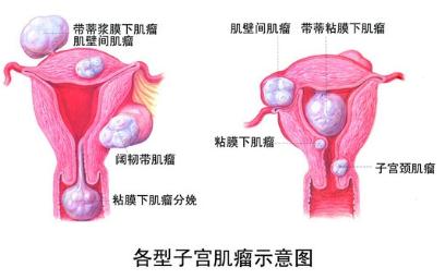 子宫囊肿对绝经女性身体有危害吗,子宫里面长了个包