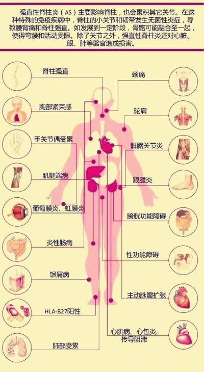 强直性脊柱炎引起虹膜炎,虹膜炎与强直性脊柱炎会失明吗