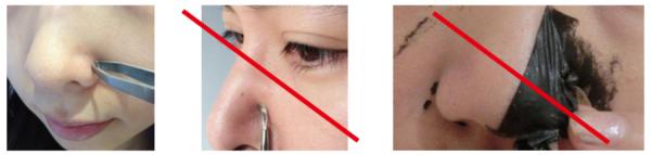 出油黑头毛孔粗大怎么办,毛孔粗大黑头多脸爱出油怎么解决