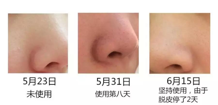 出油黑头毛孔粗大怎么办,毛孔粗大黑头多脸爱出油怎么解决