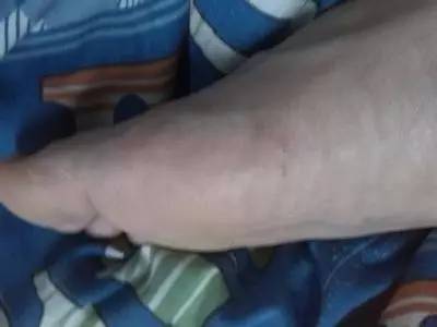 脚板磨出水泡还能继续打球吗,打球磨出水泡怎样处理