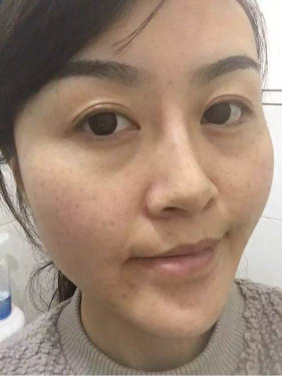 十岁女孩脸上长斑怎么才能淡化,吃什么能淡化脸上的斑和黑色素