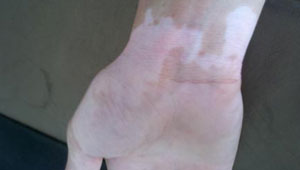 烫伤后的白癜风能治好吗,鳗鱼油膏能治好白癜风吗