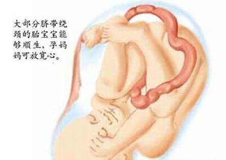 助产士不负责导致胎儿不好,助产士没有接住产道出来的新生儿