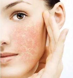 皮肤过敏还有点痒能用防晒霜吗,防晒霜里面什么东西最容易过敏