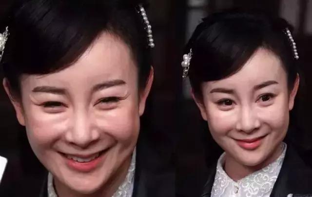 玻尿酸注射后二个月有什么变化,注射玻尿酸脸部血管堵塞的症状