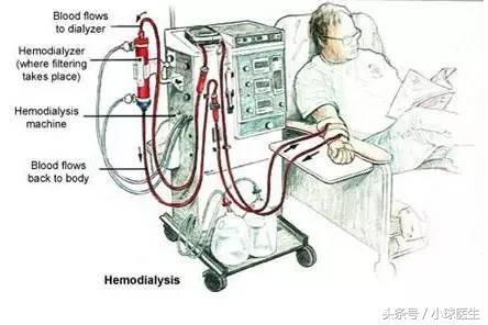 肾病选择腹透还是血透,血透和腹透哪个质量高