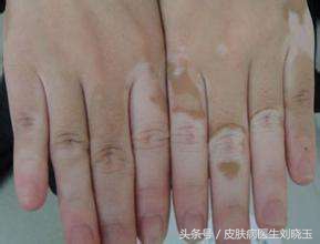 白癜风名医药方,治疗白癜风著名专家护理措施