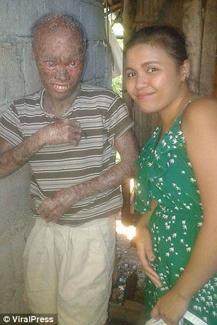 全身被烧伤后的皮肤,皮肤烧伤起皮疹