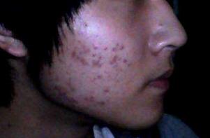 青岛修复青春痘疤痕,脸上青春痘凹陷疤痕怎么修复