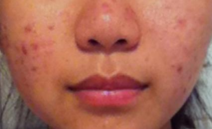 青岛修复青春痘疤痕,脸上青春痘凹陷疤痕怎么修复