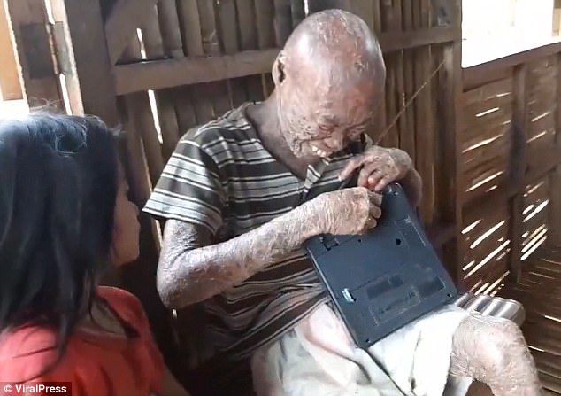 全身被烧伤后的皮肤,皮肤烧伤起皮疹