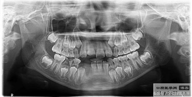 宝宝不小心磕到头有事吗,如果乳牙被磕伤了怎么办