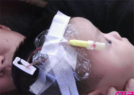 宝宝额头摔个大包一直存在,宝宝额头摔个大包扩散了怎么办