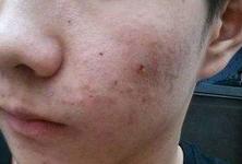青岛修复青春痘疤痕,脸上青春痘凹陷疤痕怎么修复