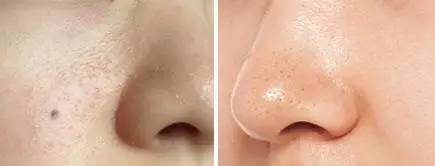 三种去黑头粉刺的小妙招,对付黑头粉刺的最好方法