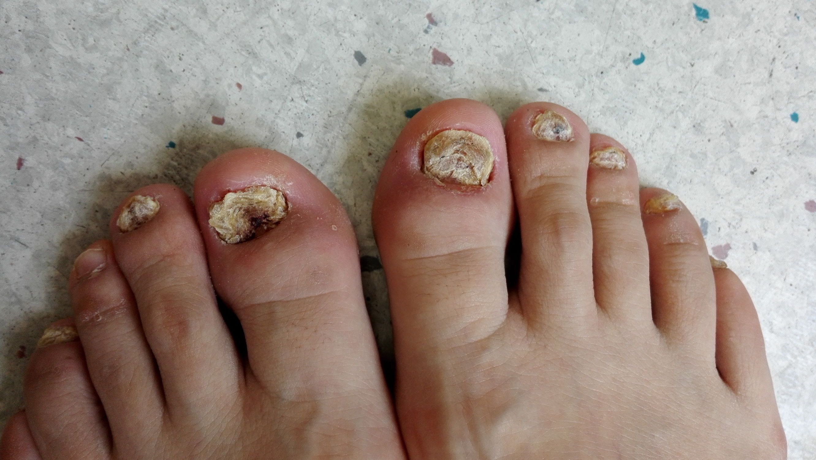 银屑病甲怎么治疗,甲砜霉素治疗银屑病