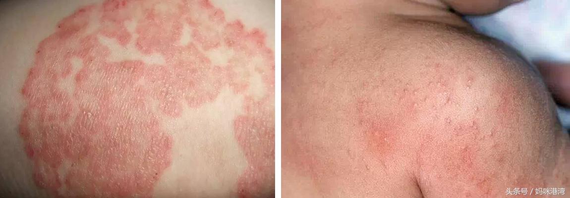 痱子、湿疹大不同，教你如何区分宝宝的痱子和湿疹