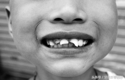 宝宝不小心磕到头有事吗,如果乳牙被磕伤了怎么办