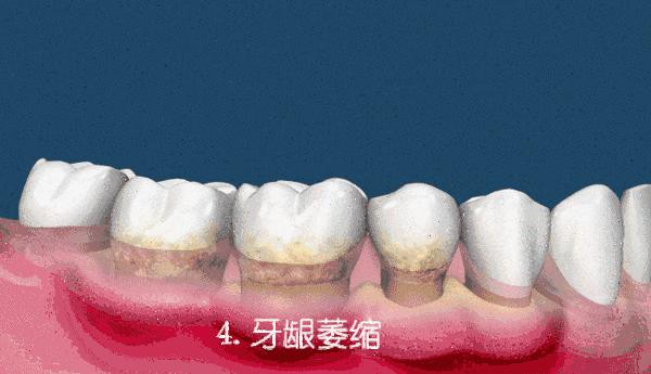 牙周病拖延不治会有什么后果,牙周病拖延有什么后果