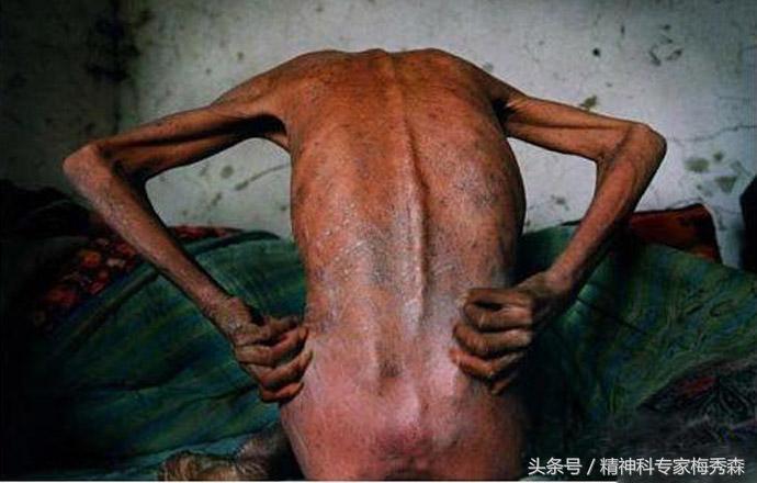 戒毒生理上会难受几天,戒毒身体会发生什么