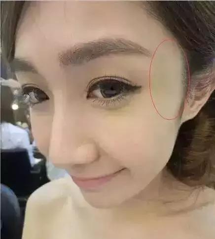 太阳穴凹陷的女人怎么破解,太阳穴凹陷的小妙招